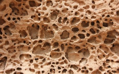 Bone Marrow Hope: 2 Inspiring Studies Transforming Aneurysmal Bone Cyst Care