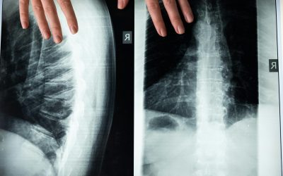 From Pain Relief to Regeneration: Advancements in Stem Cell Therapy for Spinal Discs