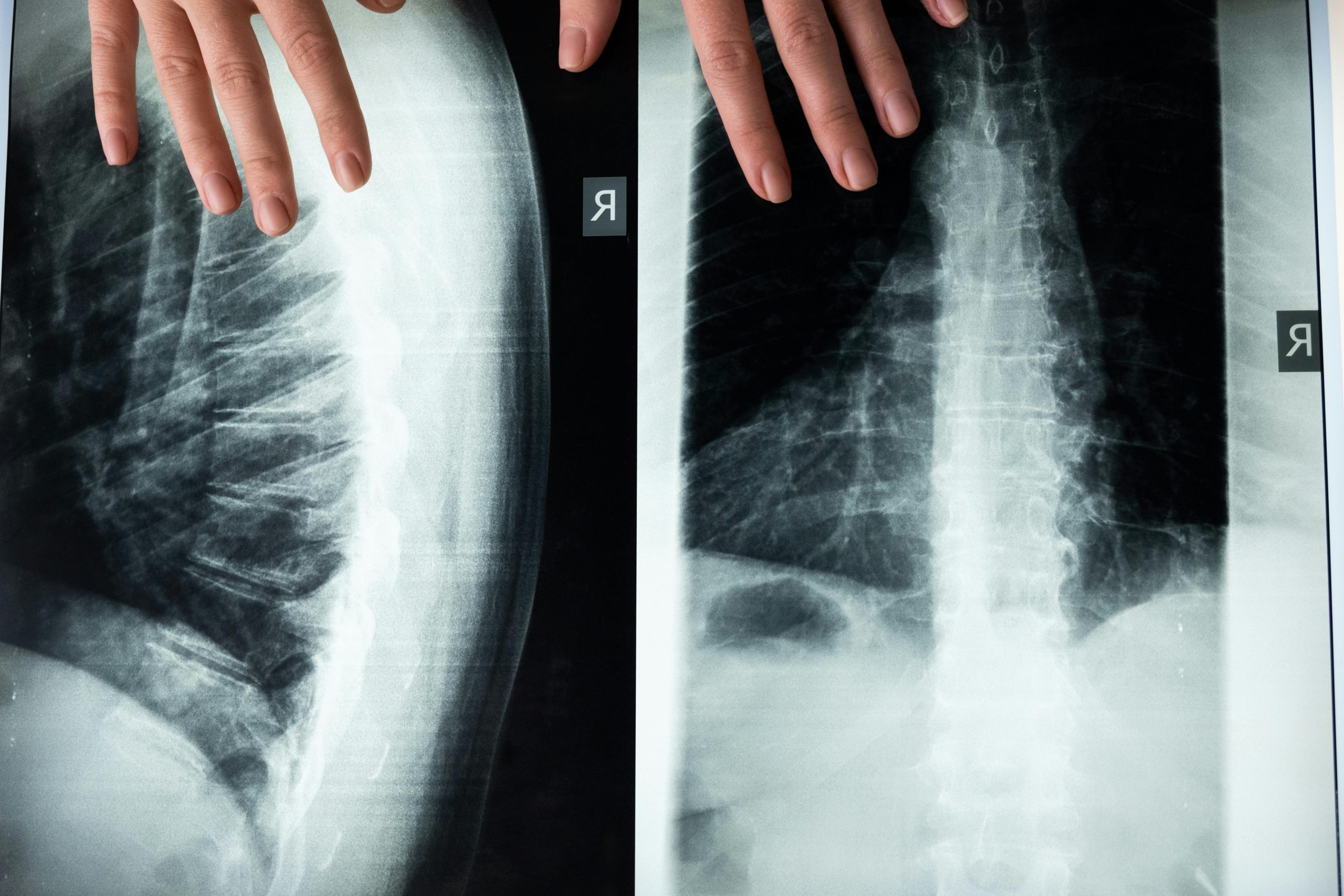 X-ray of the human spine highlighting spinal discs, used to illustrate how stem cell therapy and hydrogels may support spinal disc regeneration.